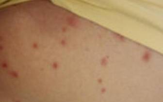 measles20130820101631_l